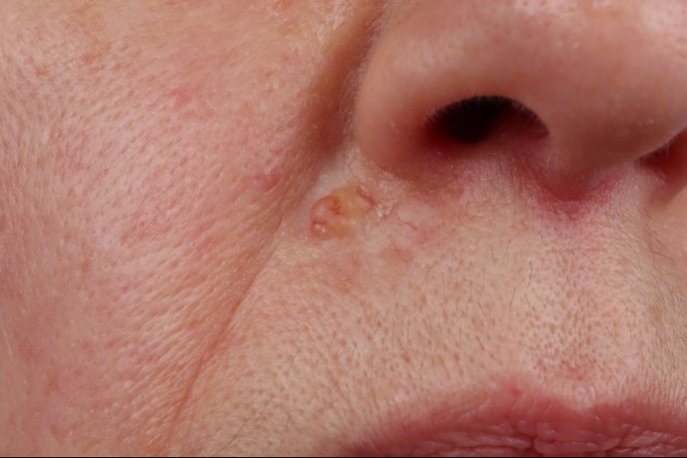 A gyomorrák tünetei, amit sokan összetévesztenek mással!