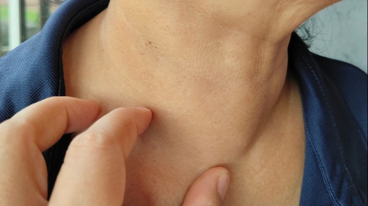 Ha pajzsmirigyproblémáid vannak, ezeket az ételeket jobb, ha kerülöd!