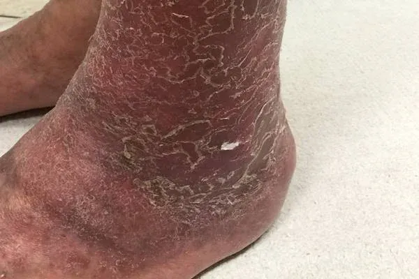 A cukorbetegség legrettegettebb következménye, amiről tudnod kell!