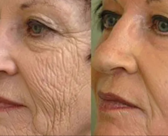 Megemeli a megereszkedett, petyhüdt arcot és ingyen van – Éveket fiatalít a külsődön