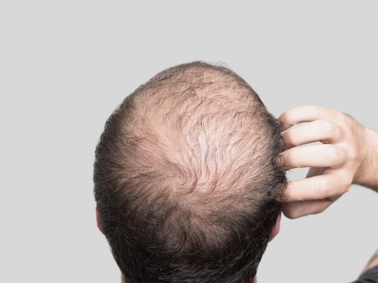 Kiderült, hogy melyik mi felelős az őszülésért és a kopaszodásért - az oka sokkoló!