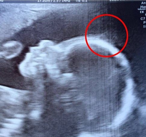 Már az ultrahangon is látszott a baba óriási hajkoronája. A szülőszobán viszont, amikor meglátták a fejét...