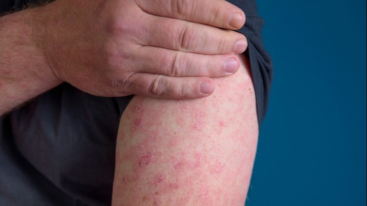 3 csillagjegy, akikre komoly betegség leselkedik idén nyáron