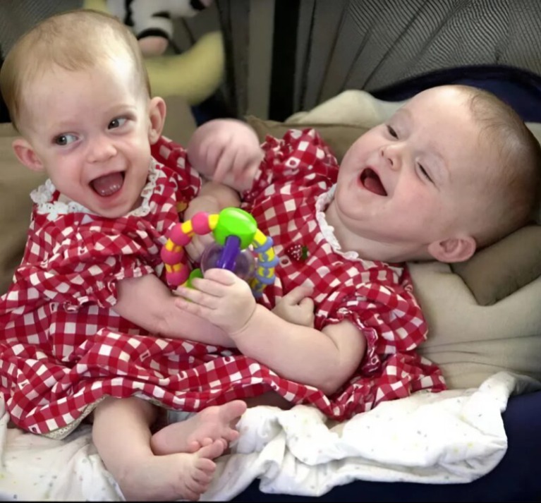 Orvosok szétválasztották a mellkasnál összenőtt sziámi ikreket: Így néznek ki 25 évvel később